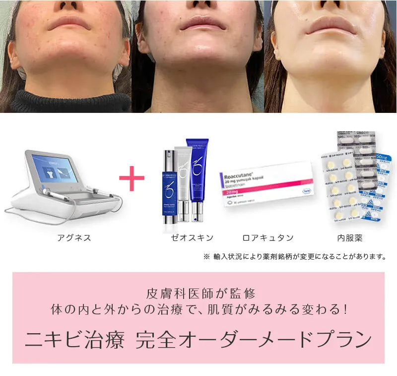 ニキビ治療 完全オーダーメードプラン