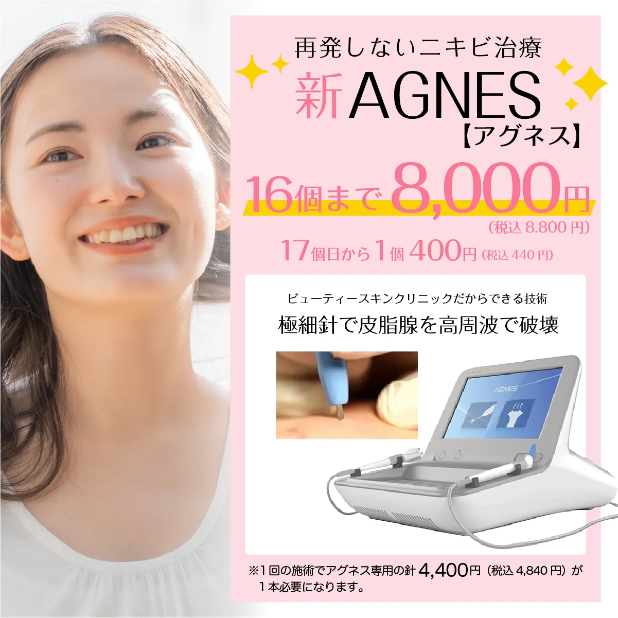 再発しないニキビ治療 新AGNES【アグネス】16個まで8,000円 17個目から1個400円