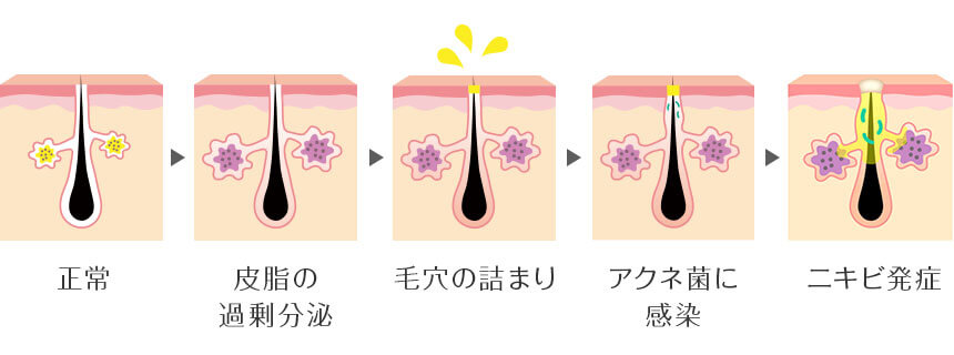 ニキビができるまで