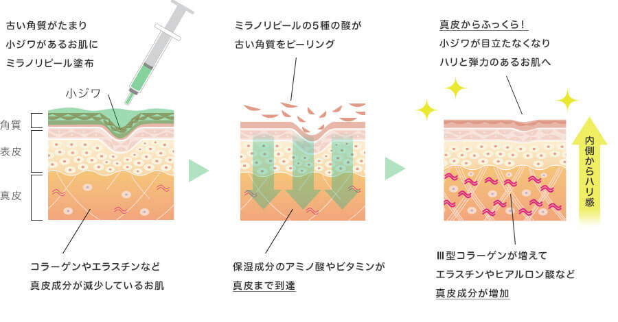 ミラノリピール(BioRePeelCl3)の施術イラスト