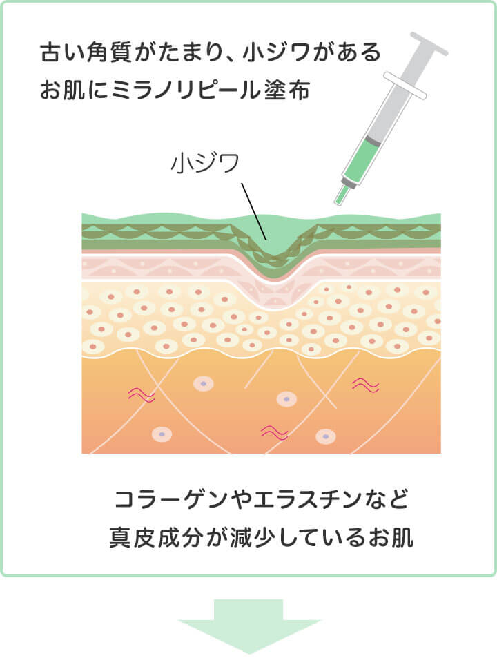ミラノリピール(BioRePeelCl3)の施術イラスト