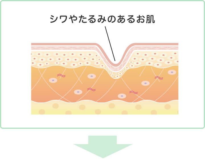 ダーマペン4の施術イラスト