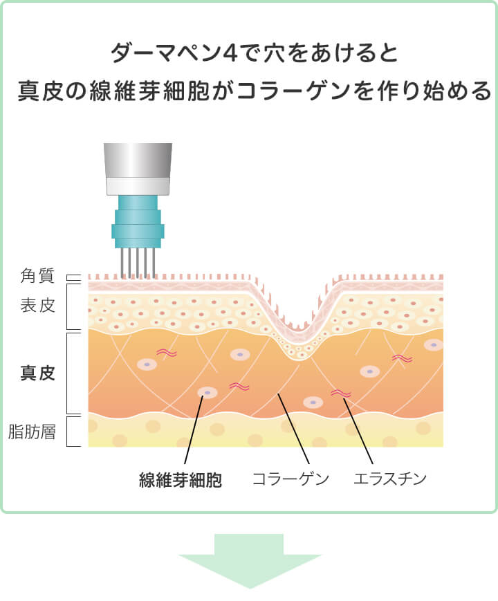 ダーマペン4の施術イラスト