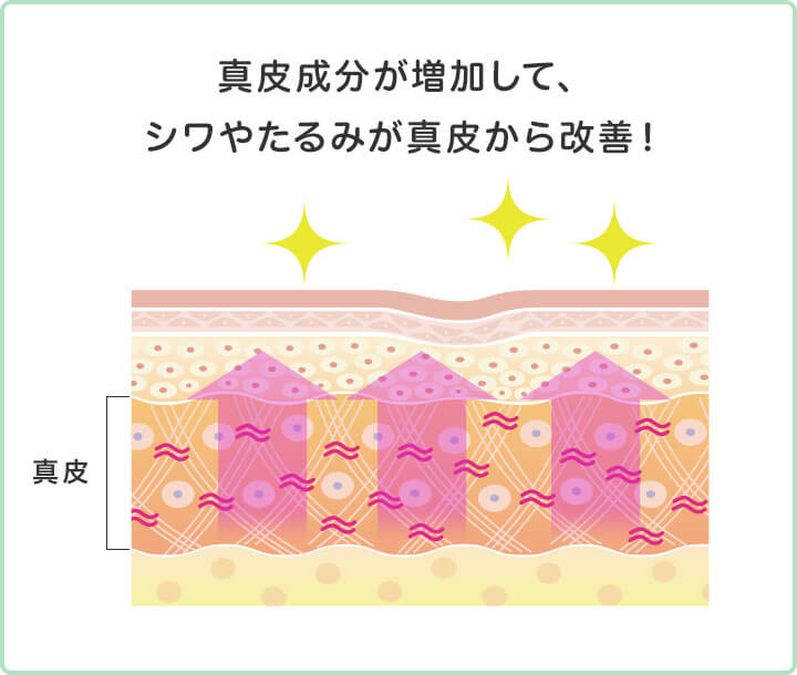 ダーマペン4の施術イラスト