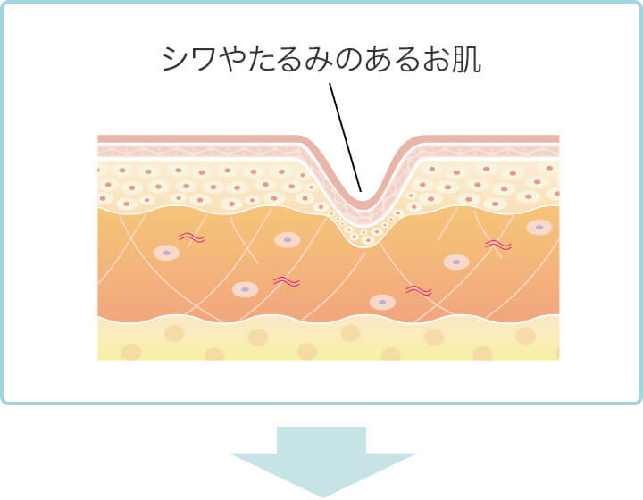 ダーマペン4の施術イラスト