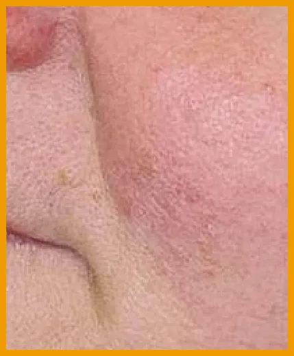 赤ら顔・酒さ 施術後