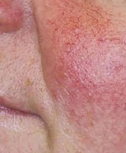 赤ら顔・酒さ 施術前