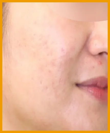 ニキビ・ニキビ跡 施術後