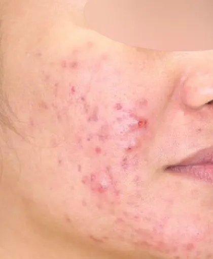 ニキビ・ニキビ跡 施術前