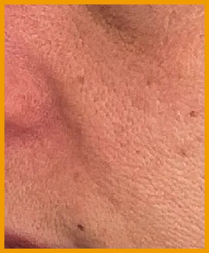 毛穴・肌質改善 施術後