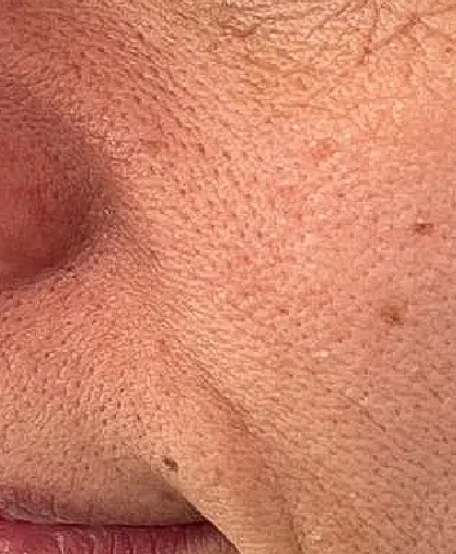 毛穴・肌質改善 施術前