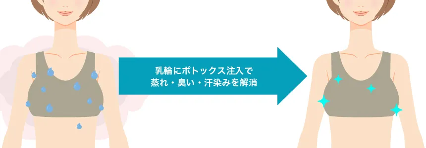 乳輪汗／臭い対策ボトックス 治療イメージ