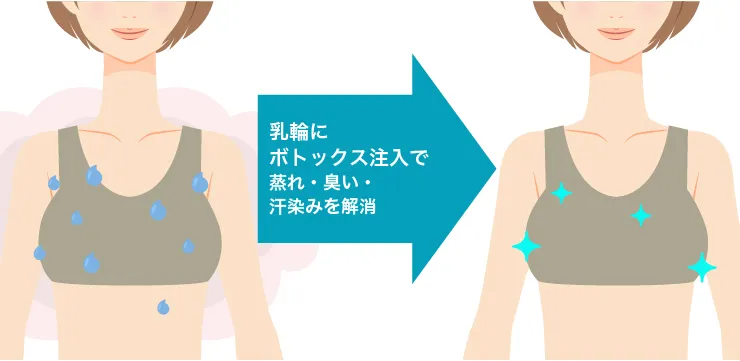 乳輪汗／臭い対策ボトックス 治療イメージ