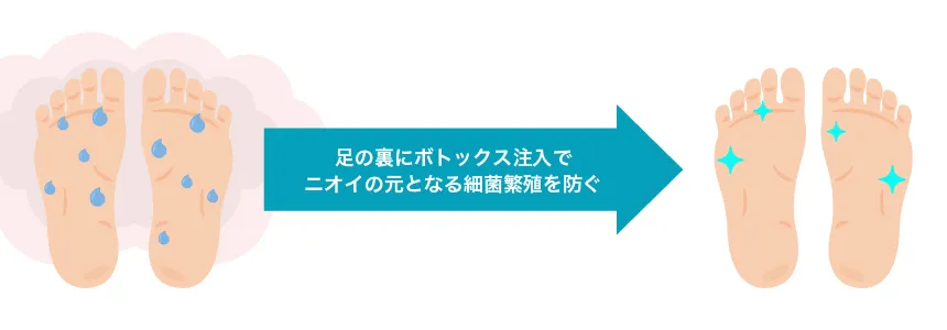 足の裏多汗／臭い対策ボトックス 治療イメージ