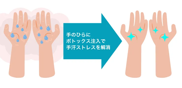 手のひら多汗症ボトックス 治療イメージ