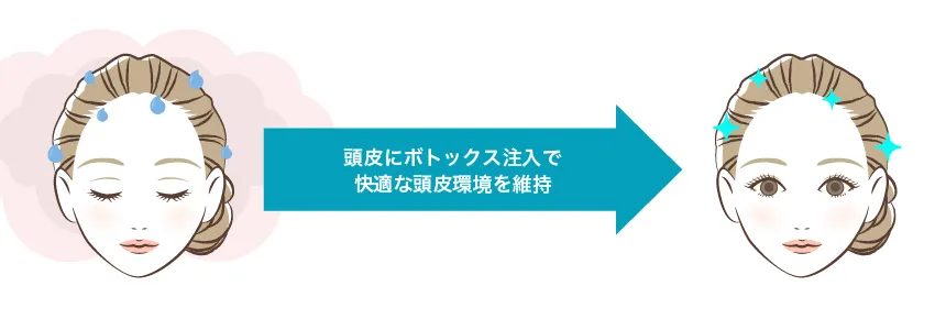頭皮汗多汗症ボトックス 治療イメージ
