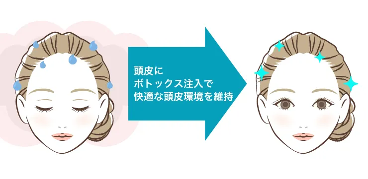 頭皮汗多汗症ボトックス 治療イメージ