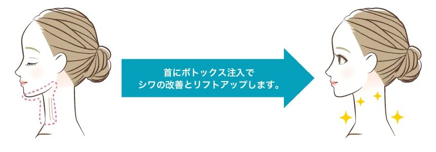 首ボトックス 治療イメージ