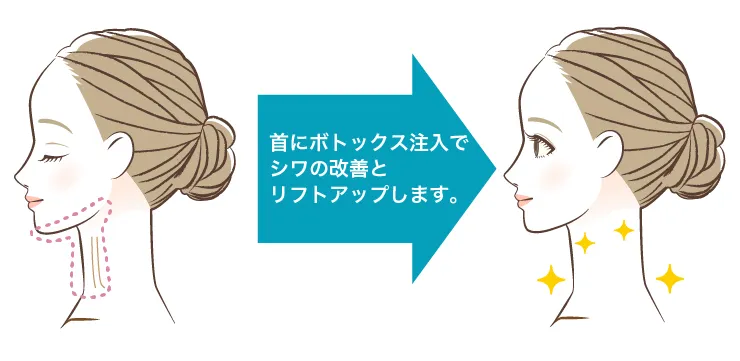 首ボトックス 治療イメージ