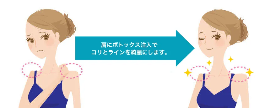 肩こり改善ボトックス 治療イメージ