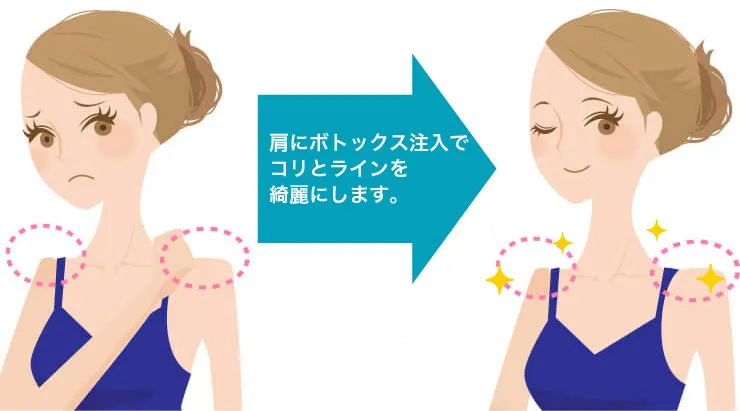 肩こり改善ボトックス 治療イメージ
