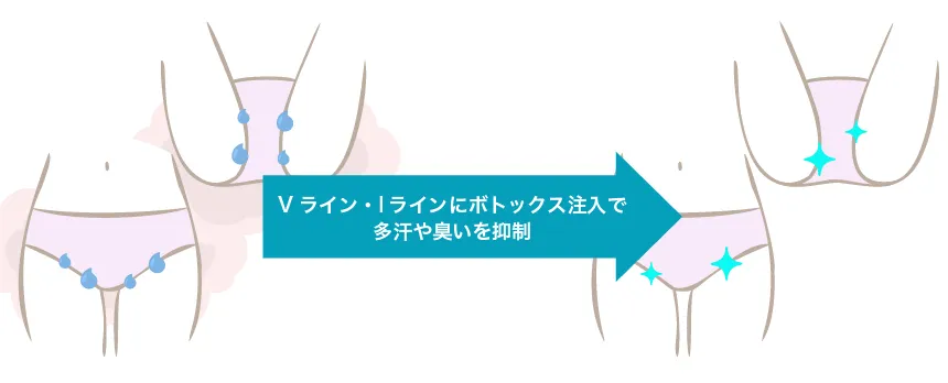 VIライン（ビキニラインの多汗・臭い対策）ボトックス 治療イメージ