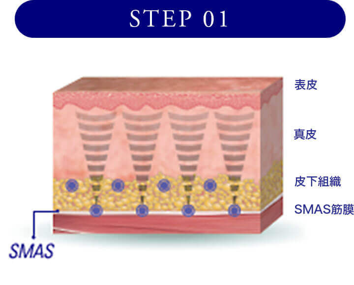 STEP1 真皮から脂肪組織、筋膜に熱エネルギーを加えます。