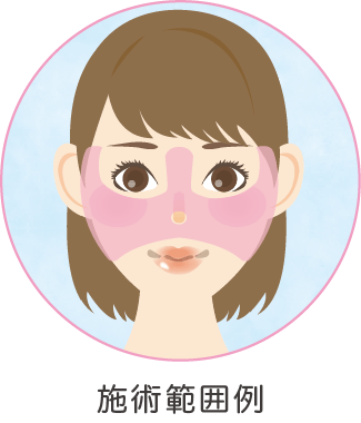 ジャルプロ スーパーハイドロ 2.5mlの施術範囲例