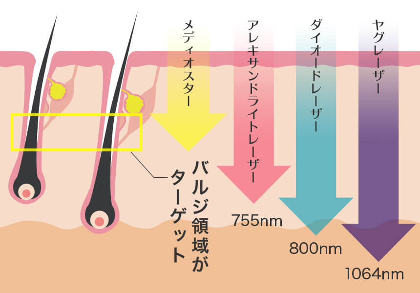 4種類の医療レーザー脱毛機を使い分けています | 新宿/渋谷の安い医療レーザー脱毛専門のビューティースキンクリニック