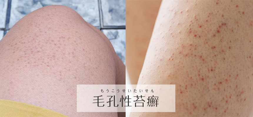 ヘアカット後に頭にぶつぶつができる原因は何ですか?