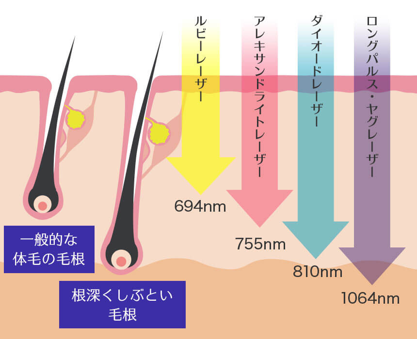 レーザー各種の波長(=脱毛効果の高さ)を比較