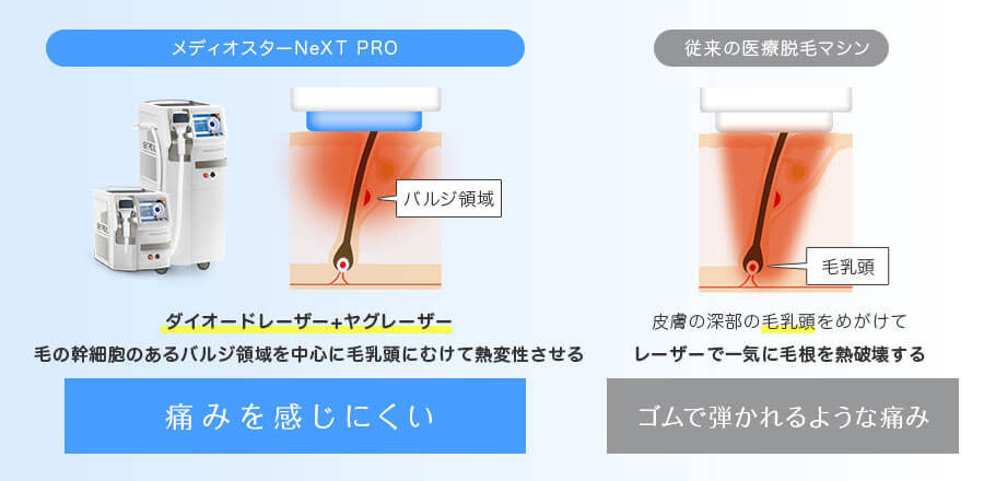 メディオスターNeXT PROはダイオードレーザー+ヤグレーザーで毛の幹細胞のあるバルジ領域を中心に毛乳頭にむけて熱変性させるので痛みを感じにくい