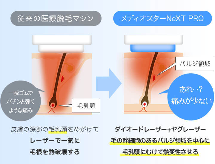 メディオスター ソプラノ選べる 全身 うなじ医療脱毛 1回23 000円 新宿のビューティースキンクリニック